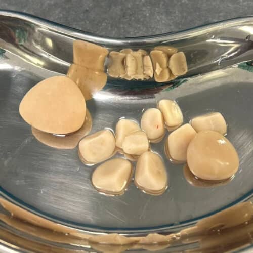 Bladder Stones which were removed from a patient at Pattenden Vets.